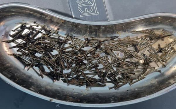 Samarqandda bemorning qornidan 200 gramm mix chiqdi