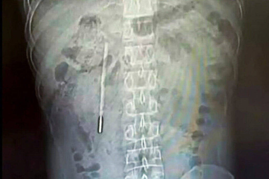 Xitoyda erkak 20 yil davomida ichakda termometr bilan yashagan