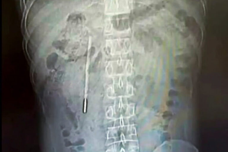 Xitoyda erkak 20 yil davomida ichakda termometr bilan yashagan